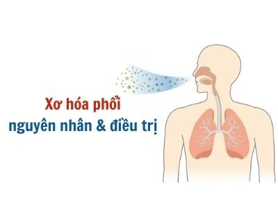 Thông tin cần biết về xơ hóa phổi và cách kiểm soát bệnh